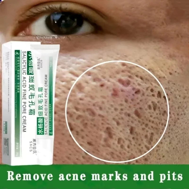 サリチル酸毛穴クリアリングクリーム毛穴を縮小黒ずみ除去にきび - Salicylic Acid Blackhead Remover のレビューと価格